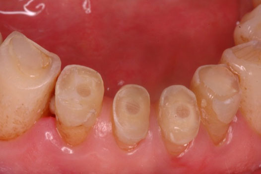 Aesthetic Indirect Restoration Workshop Clinical Cases