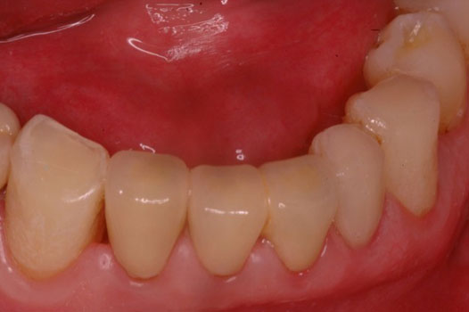 Aesthetic Indirect Restoration Workshop Clinical Cases