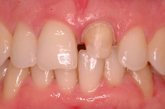Aesthetic Indirect Restoration Workshop Clinical Cases