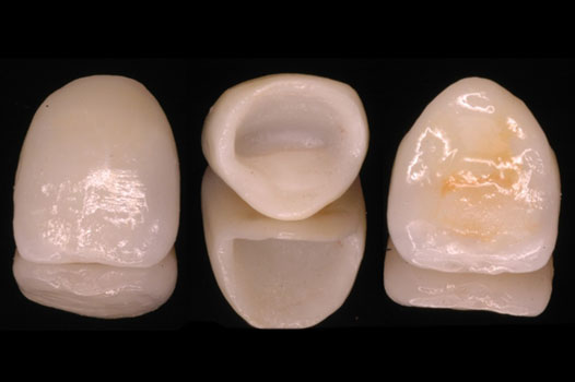 Aesthetic Indirect Restoration Workshop Clinical Cases