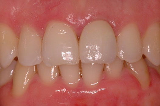 Aesthetic Indirect Restoration Workshop Clinical Cases