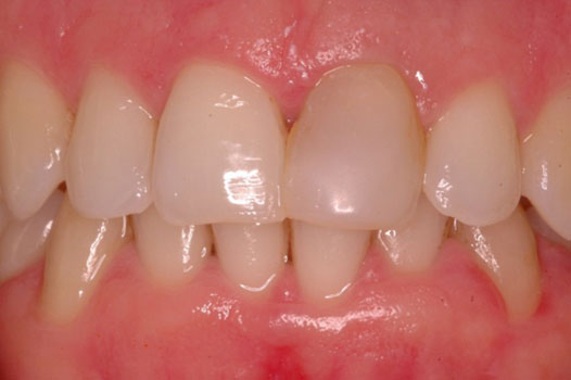Aesthetic Indirect Restoration Workshop Clinical Cases