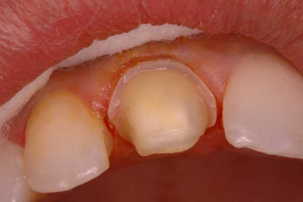 Gingival Retraction & Impression