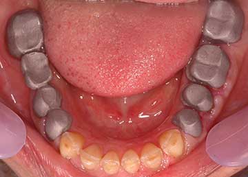 Importance of Coping & Bisque Trial