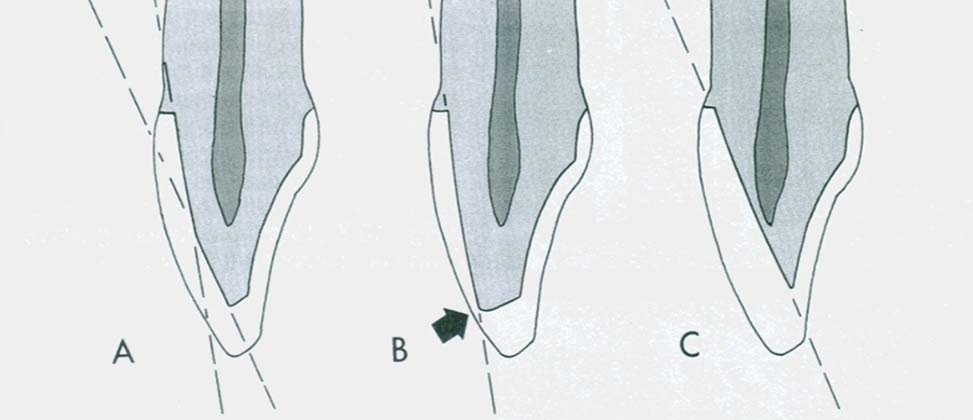 Posterior Restorations
