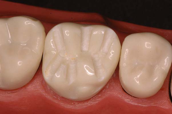 Tooth Preparation for Posterior Teeth