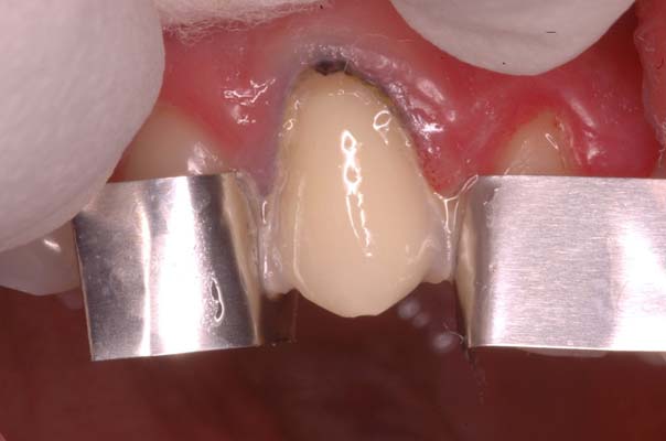 Cementation of Porcelain Laminate