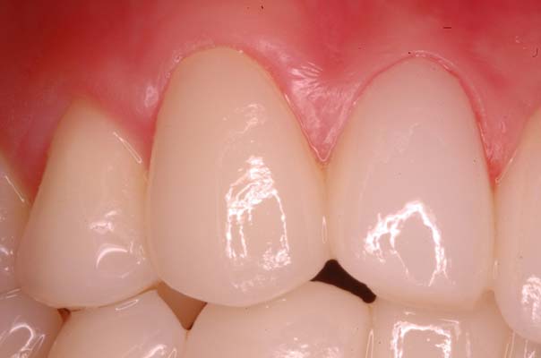 Cementation of Porcelain Laminate