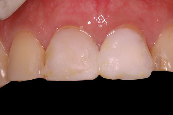 Smile Design and Treatment Planning
