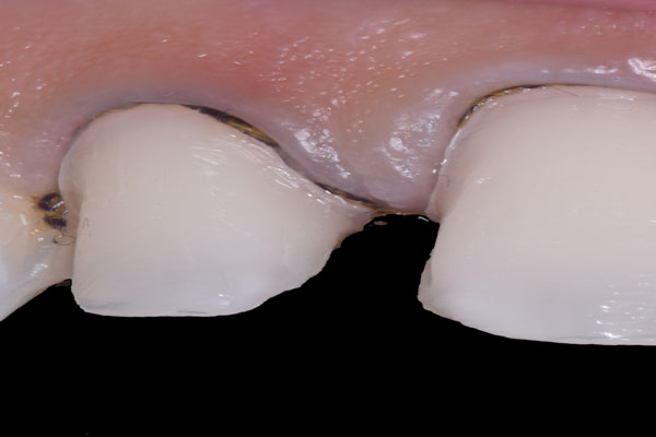 Smile Design and Treatment Planning