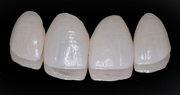 Porcelain Laminate – Step by step Tooth Preparation