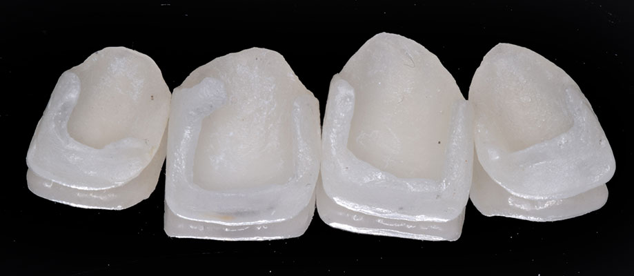 Porcelain Laminate – Step by step Tooth Preparation
