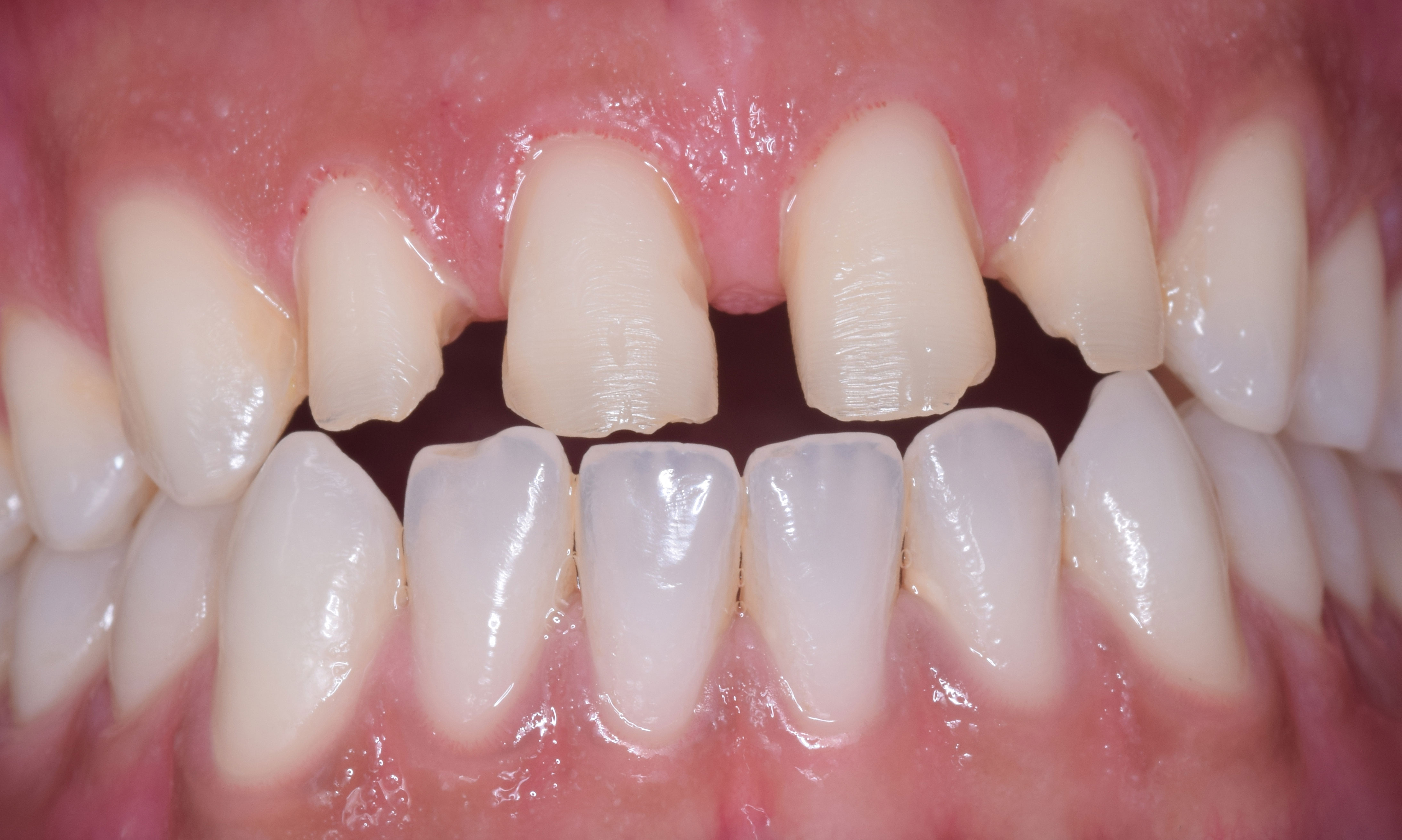Porcelain Laminate – Step by step Tooth Preparation