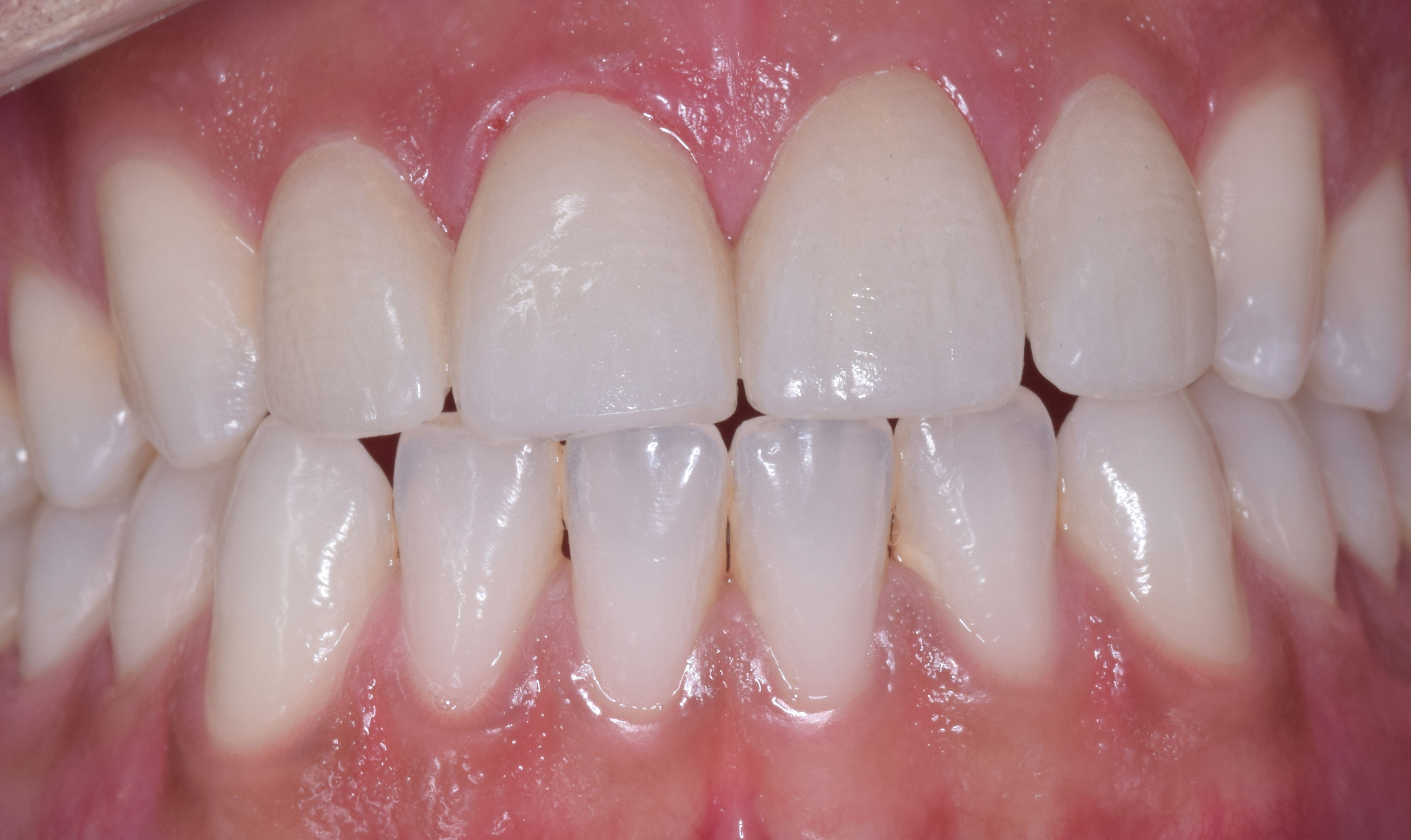 Porcelain Laminate – Step by step Tooth Preparation
