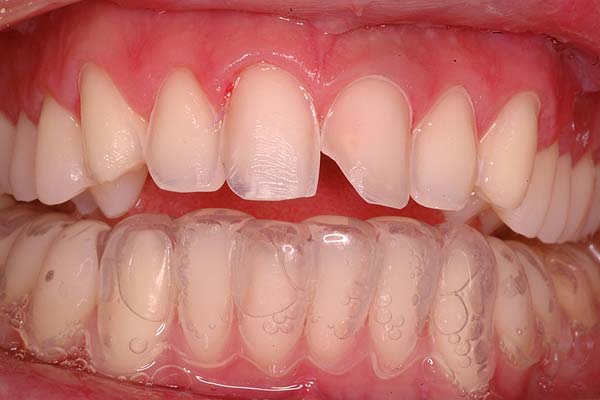 Role of Provisional , Materials & Techniques