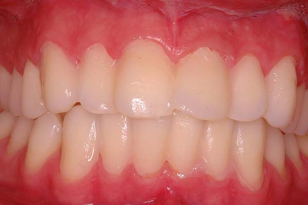 Role of Provisional , Materials & Techniques