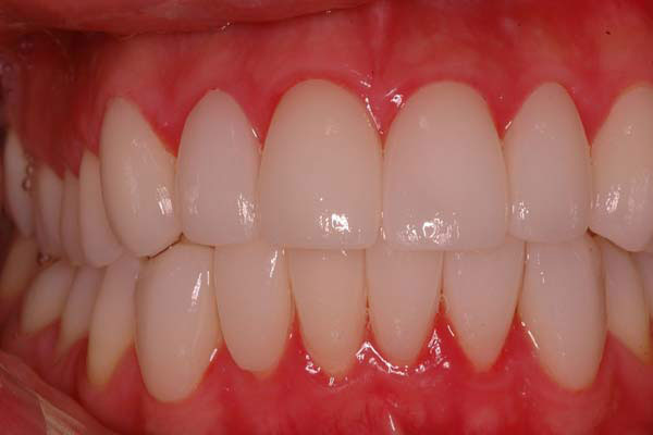 Try in of Porcelain Laminate